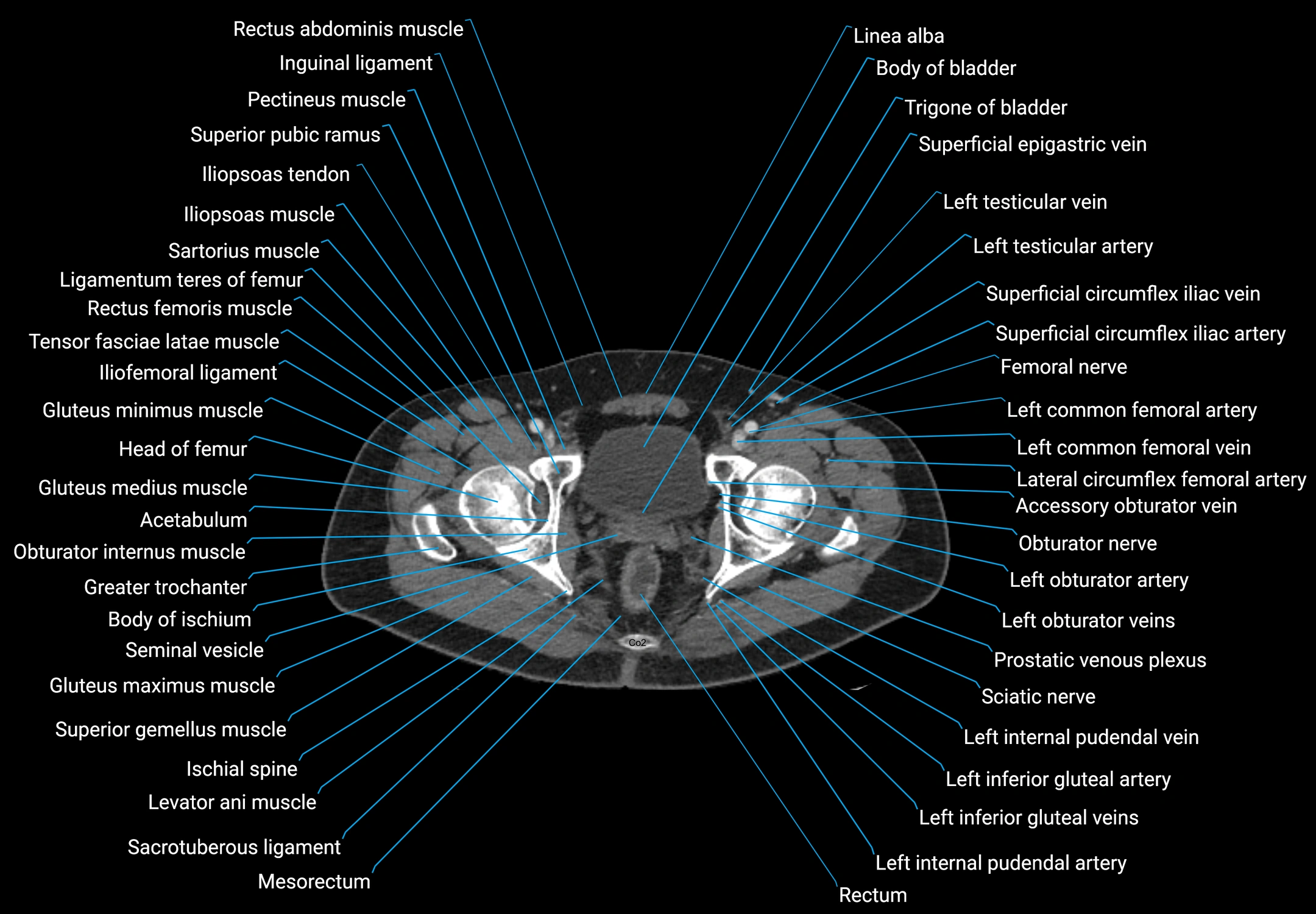 CT male pelvis axial cross sectional anatomy labelled radiology image -00188.webp